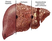 obat alami penyakit hepatitis
